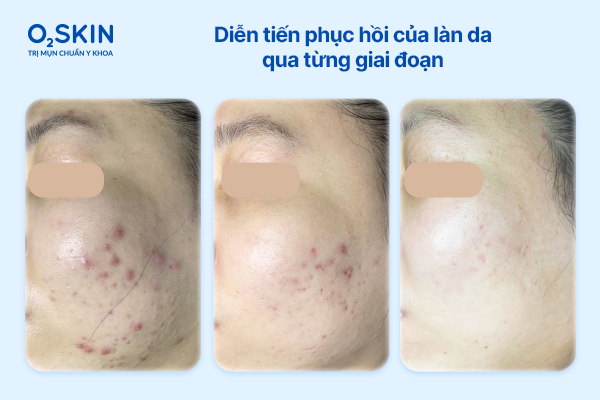 dien-tien-phuc-hoi-da-sau-qua-trinh-dieu-tri-mun-o2skin