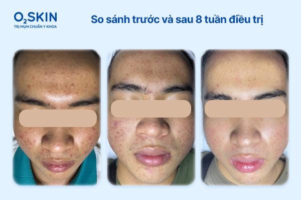 So sánh trước và sau 8 tuần điều trị