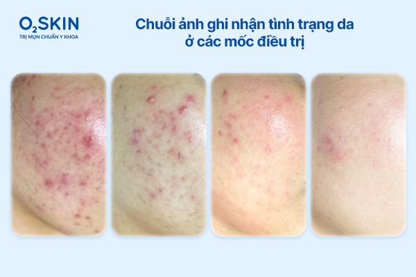 hanh-trinh-cai-thien-da-qua-cac-giai-doan-dieu-tri-mun-tai-phat-nhieu-lan