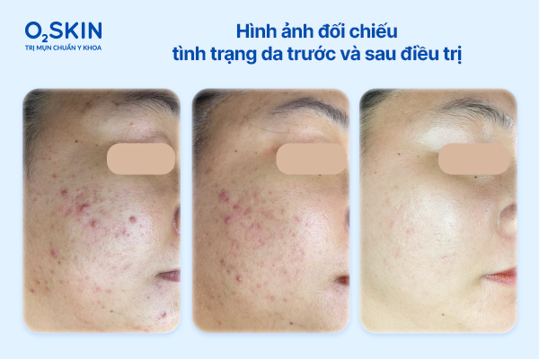 Hình ảnh đối chiếu tình trạng da trước và sau điều trị hinh-anh-doi-chieu-da-truoc-va-sau-dieu-tri-mun-o2skin