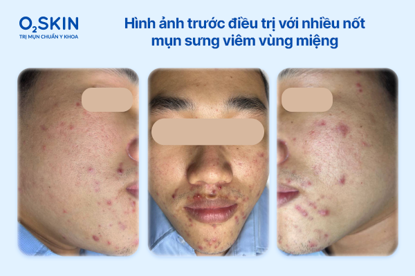 Hình ảnh trước điều trị với nhiều nốt mụn sưng viêm vùng miệng