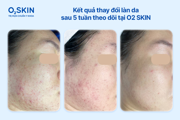 Kết quả thay đổi làn da sau 5 tuần theo dõi tại O2 SKIN