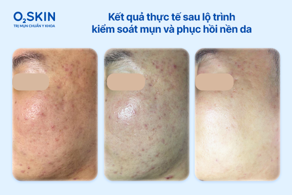 ket-qua-thuc-te-sau-lo-trinh-kiem-soat-mun-va-phuc-hoi-nen-da-o2skin