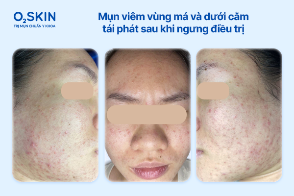Hình ảnh vùng dưới cằm và má ghi nhận mụn viêm lan rộng