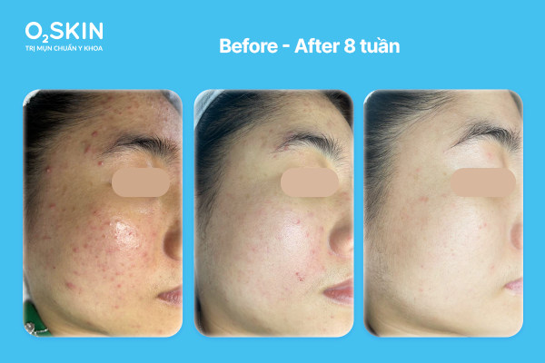 Phục hồi da treatment chồng chéo sau 8 tuần