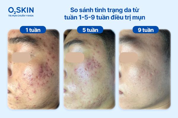 So sánh tình trạng da từ tuần 1-5-9 tuần điều trị mụn