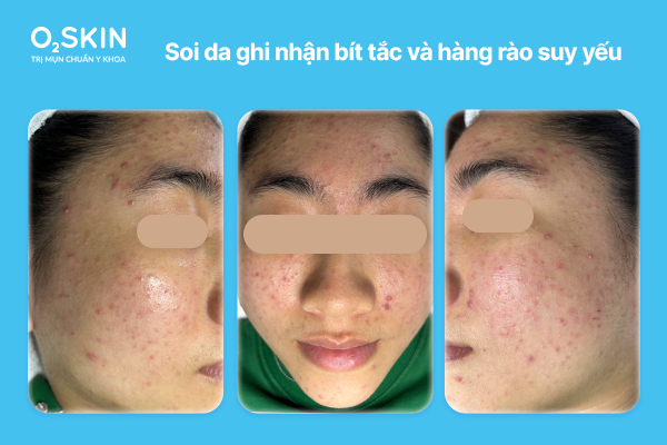 Soi da ghi nhận bít tắc và hàng rào suy yếu