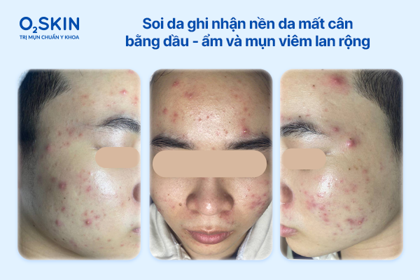 oi da ghi nhận nền da mất cân bằng dầu - ẩm và mụn viêm lan rộng