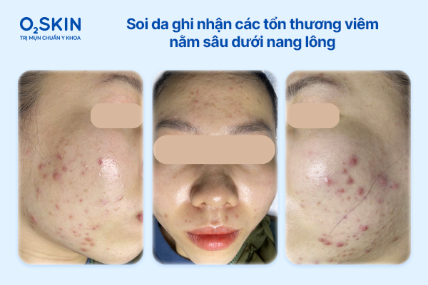 soi-da-ghi-nhan-ton-thuong-viem-sau-duoi-nang-long-o2skin
