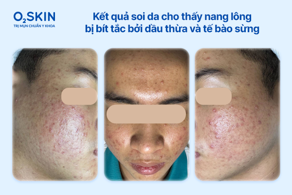 Kết quả soi da cho thấy nang lông vùng trán bị bít tắc bởi dầu thừa và tế bào sừng