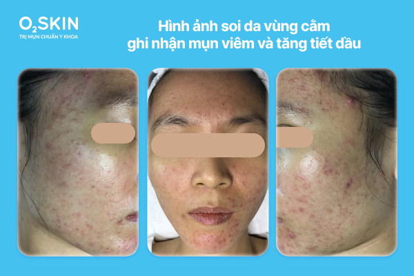 Hình ảnh soi da vùng cằm ghi nhận mụn viêm và tăng tiết dầu