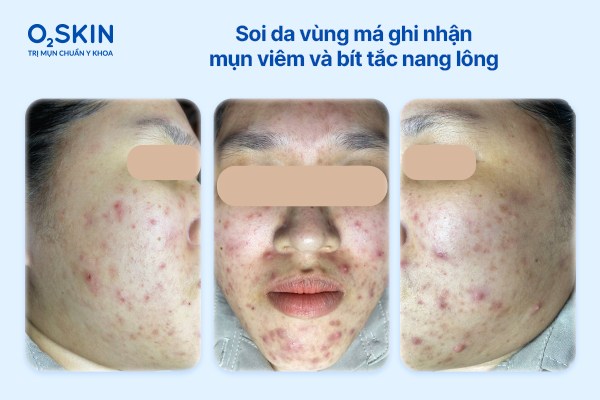 Soi da vùng má ghi nhận mụn viêm và bít tắc nang lông