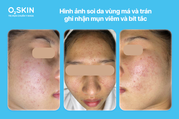 Hình ảnh soi da vùng má và trán ghi nhận mụn viêm và bít tắc