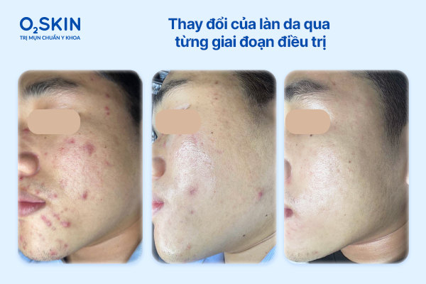 Thay đổi của làn da qua từng giai đoạn điều trị