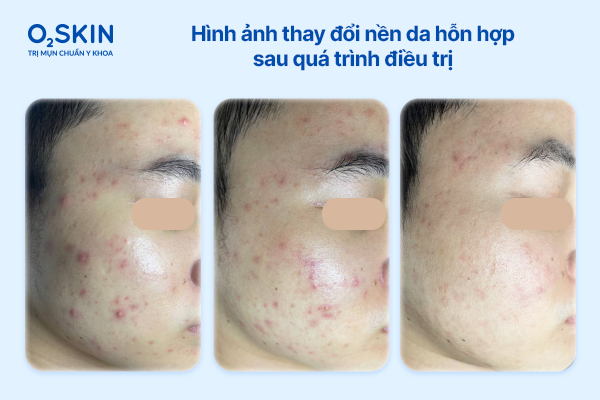 Hình ảnh thay đổi nền da hỗn hợp sau quá trình điều trị