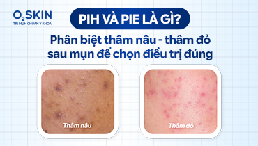 PIH và PIE là gì Phân biệt thâm nâu thâm đỏ sau mụn để chọn điều trị đúng