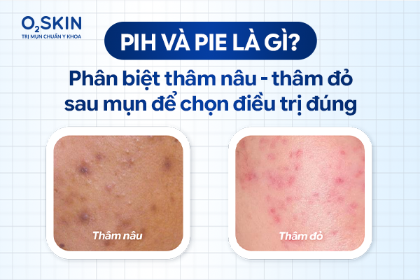 PIH và PIE là gì Phân biệt thâm nâu thâm đỏ sau mụn để chọn điều trị đúng