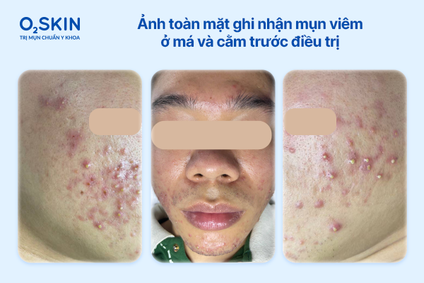 anh-toan-canh-khuon-mat-mun-viem-o-ma-va-cam-truoc-dieu-tri-o2skin