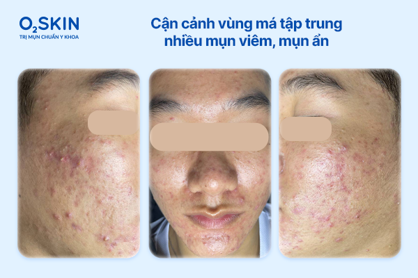 Cận cảnh vùng má tập trung nhiều mụn viêm, mụn ẩn can-canh-vung-ma-tap-trung-nhieu-mun-viem-mun-an-o2skin