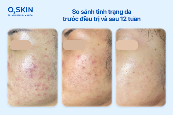 ket-qua-cai-thien-mun-viem-sau-12-tuan-dieu-tri-o2skin
