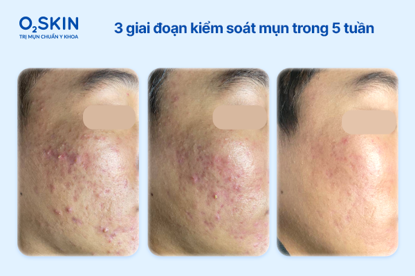 3 giai đoạn kiểm soát mụn trong 5 tuần lo-trinh-kiem-soat-mun-theo-tung-giai-doan-trong-5-tuan-o2skin