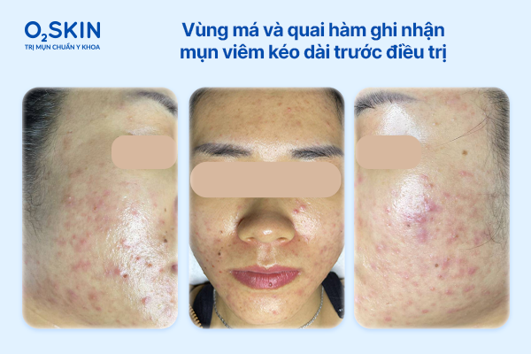 mun-viem-vung-ma-va-quai-ham-keo-dai-do-thieu-danh-gia-tong-the-nguyen-nhan-o2skin