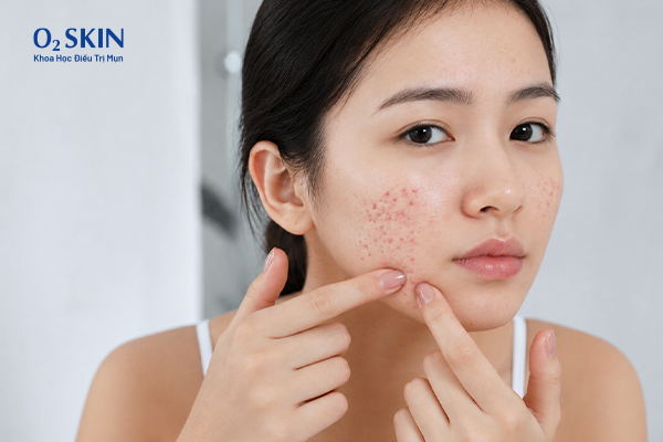 Sai lầm khi lựa chọn phương pháp trị thâm