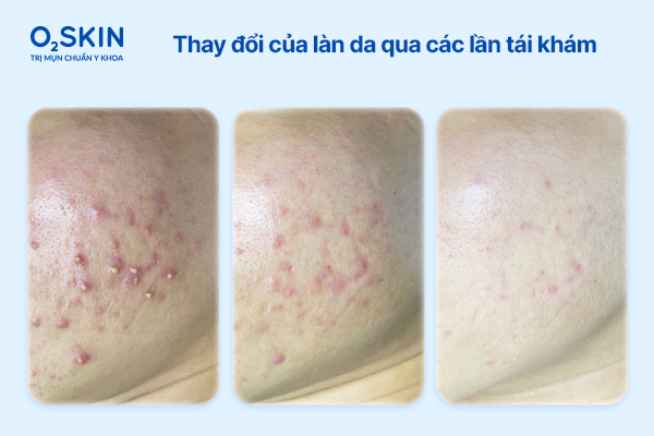 thay-doi-da-kich-ung-qua-cac-lan-tai-kham-o2skin