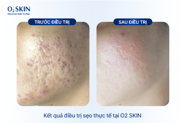 Kết quả điều trị sẹo thực tế tại O2 SKIN Đỗ Phương Nam