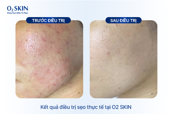 Kết quả điều trị sẹo thực tế tại O2 SKIN Huyền Trâm