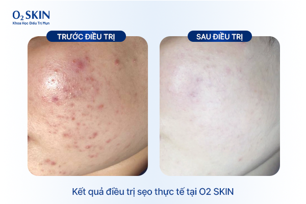 Kết quả điều trị sẹo thực tế tại O2 SKIN Trương Tuệ Lâm