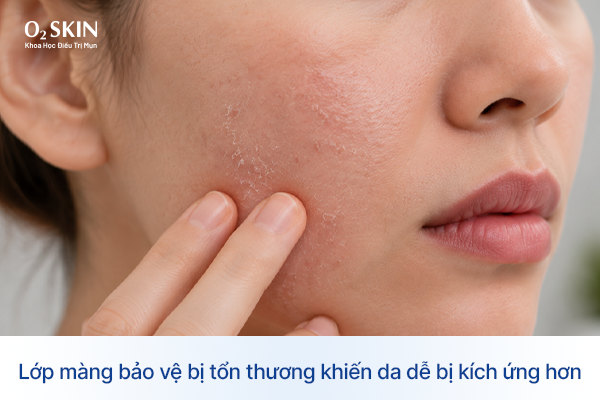 Lớp màng bảo vệ bị tổn thương khiến da dễ bị kích ứng hơn