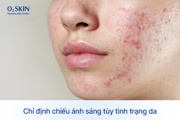Vai trò của chiếu ánh sáng năng lượng cao