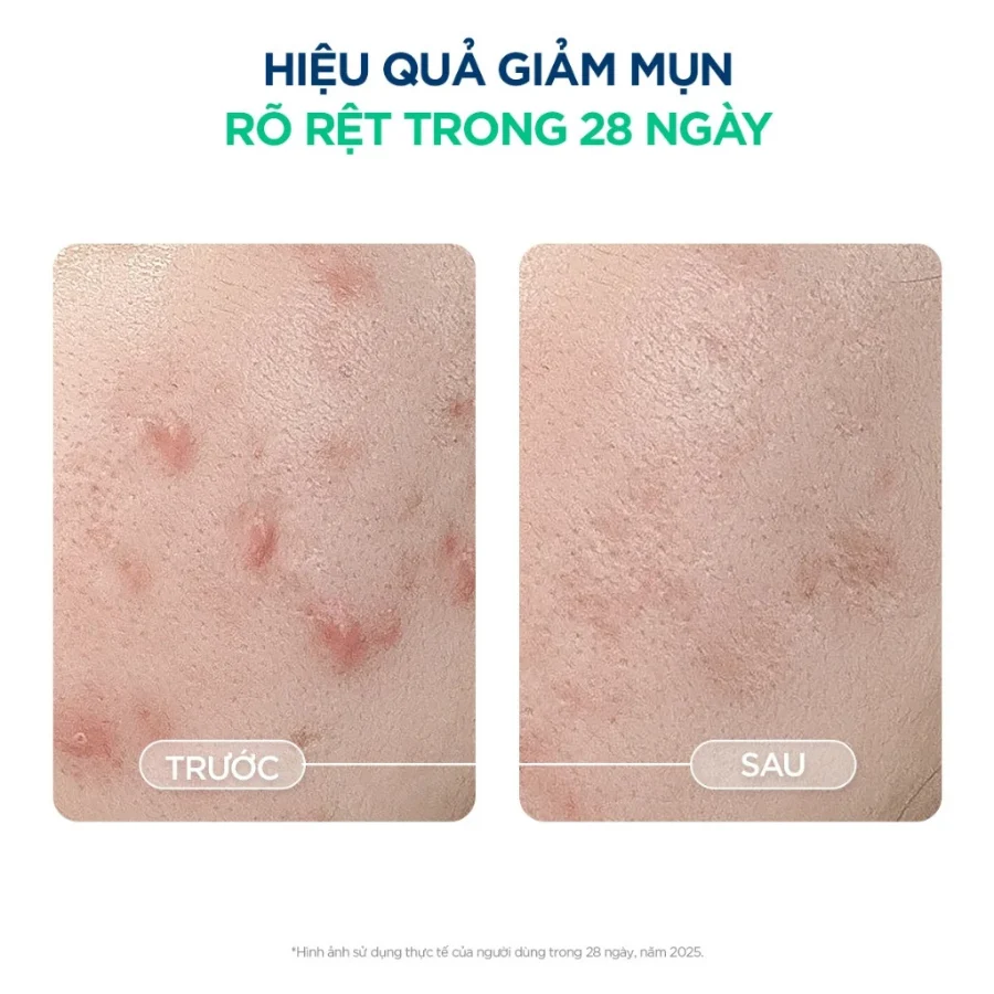 Kem dưỡng ẩm cho da nhờn mụn, nhạy cảm Bioderma Sébium Sensitive 30ml (màu xanh) - hình ảnh 4 tại Nhà thuốc O2 SKIN