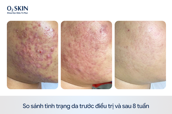 So sánh tình trạng da trước điều trị và sau 8 tuần