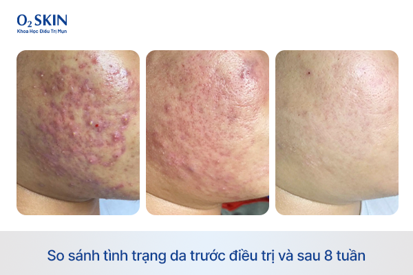 So sánh tình trạng da trước điều trị và sau 8 tuần