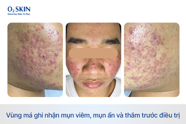 Hình ảnh vùng má ghi nhận mụn viêm, mụn ẩn và thâm trước điều trị