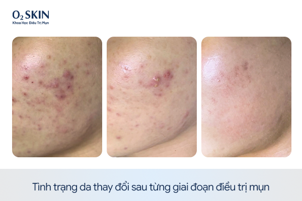 Tình trạng da thay đổi sau từng giai đoạn điều trị mụn