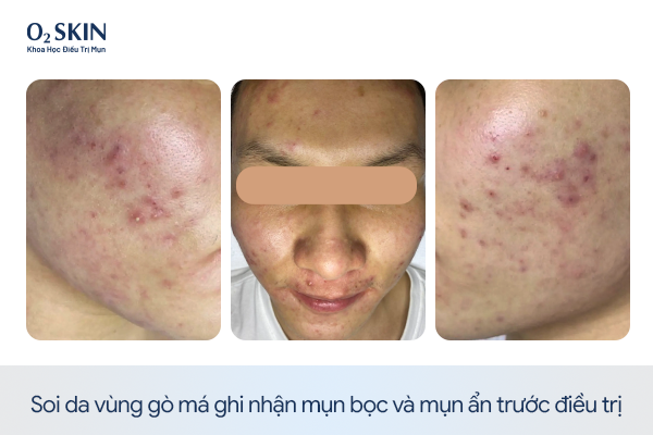 Soi da vùng gò má ghi nhận mụn bọc và mụn ẩn trước điều trị