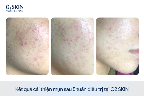 So sánh tình trạng da của Tường Vy trước và sau 5 tuần điều trị