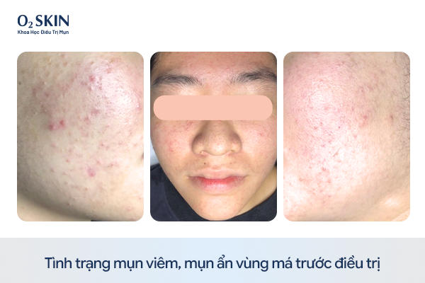 Tình trạng mụn viêm trước khi điều trị